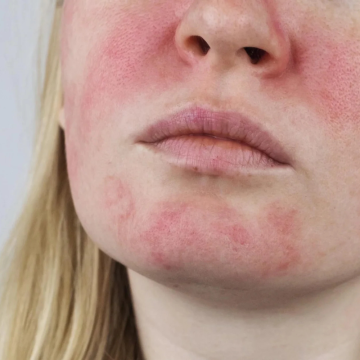 Ekzém a alergie - Novinky