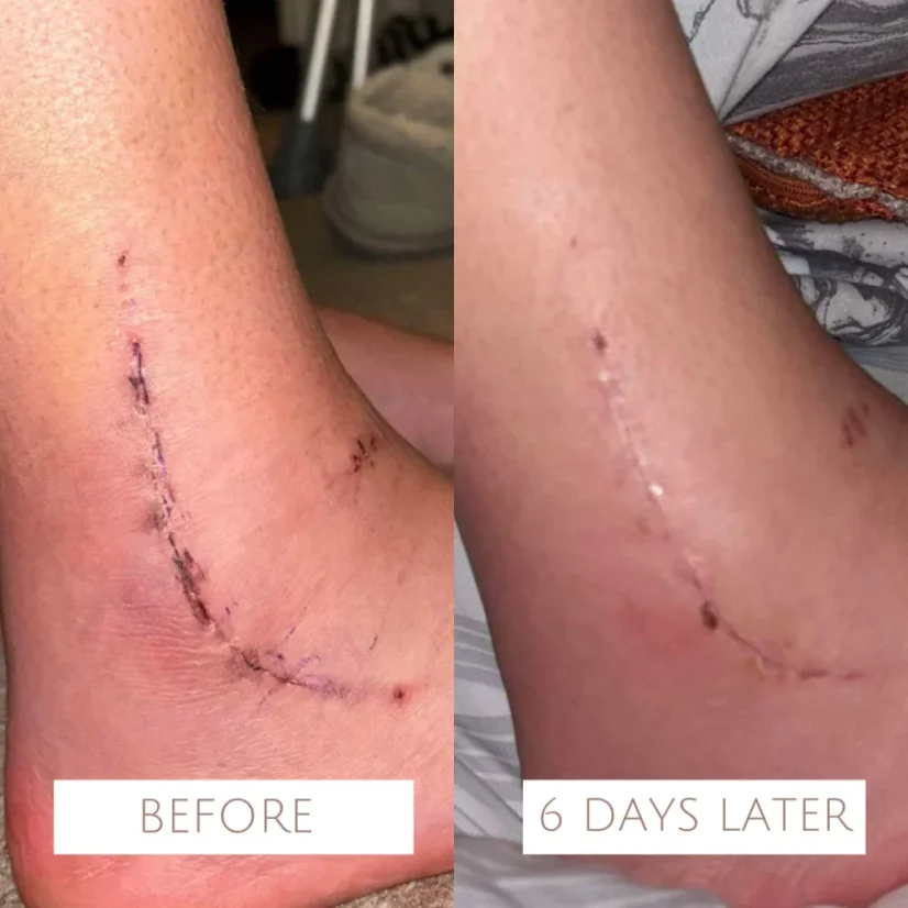 Jane Scrivner Scar drops - olej na jizvy